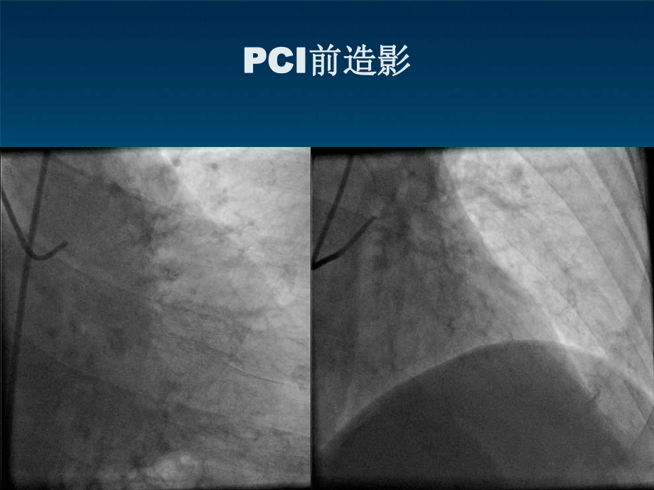 冠脉导丝引起冠脉小血管穿孔病例分析课件.ppt_第3页