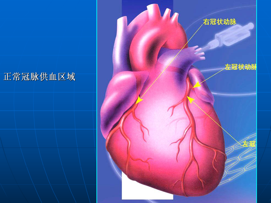 内科学-冠状动脉粥样硬化心脏病课件.ppt_第2页