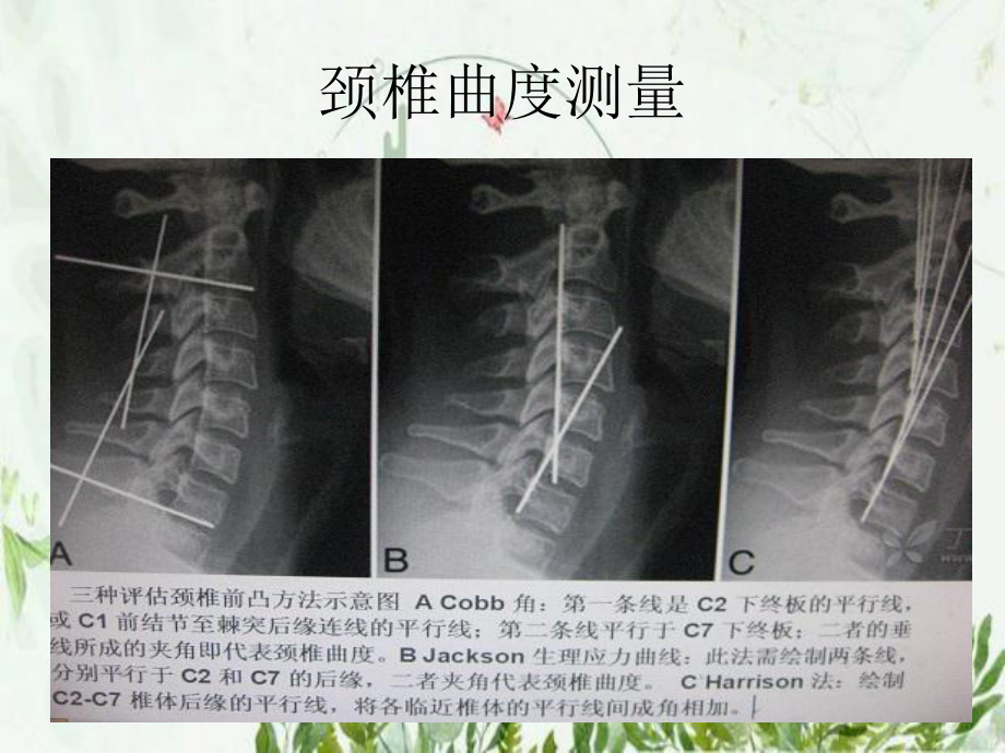 常用脊柱测量方法及其临床意义-图文课件.pptx_第2页