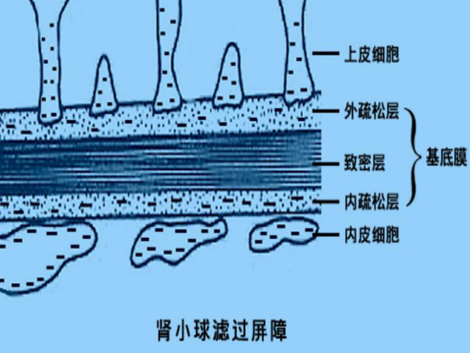 急性肾小球肾炎-教学课件.ppt_第3页