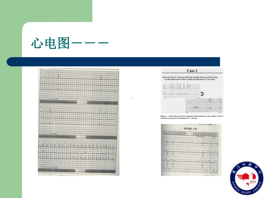 房颤相关缓慢心律失常[福州]精美医学课件.ppt_第2页