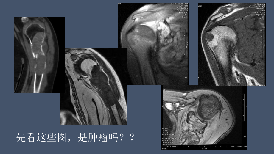 影像诊断学习与扩展：代谢性骨病(病例23)课件.pptx_第3页