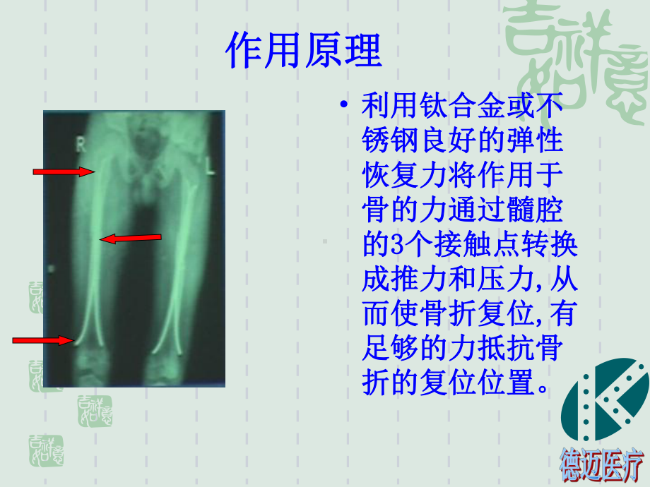 弹性髓内钉课件.ppt_第3页