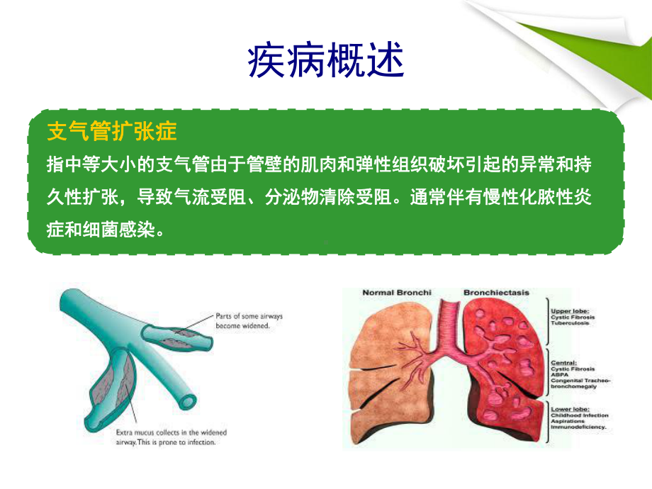 支气管扩张一例-病例分析讨论汇报-seminar-ppt课件.ppt_第2页