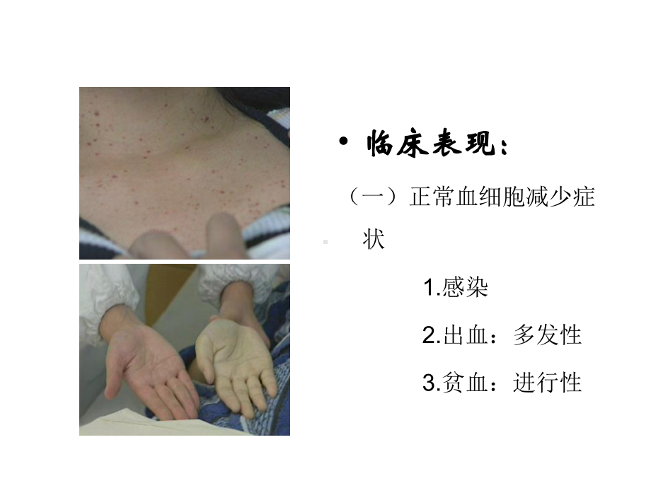 急性白血病治疗和进展课件.ppt_第3页