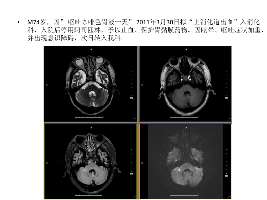 溶栓后出血病例分享课件.pptx_第3页