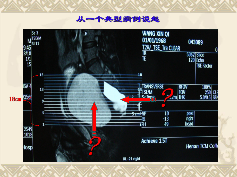 直肠后多发囊性畸胎瘤的诊治体会课件.ppt_第2页