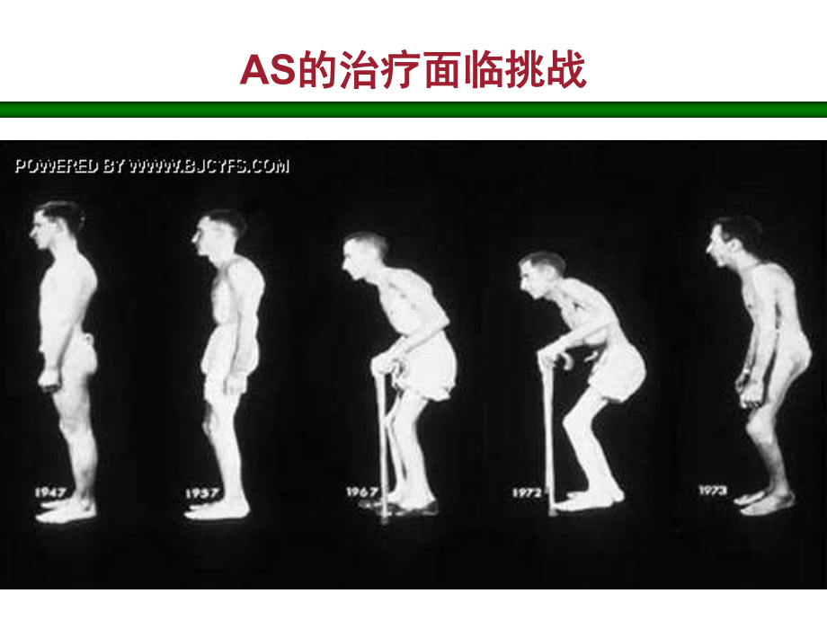 益赛普治疗强直性脊柱炎ppt课件.ppt_第2页