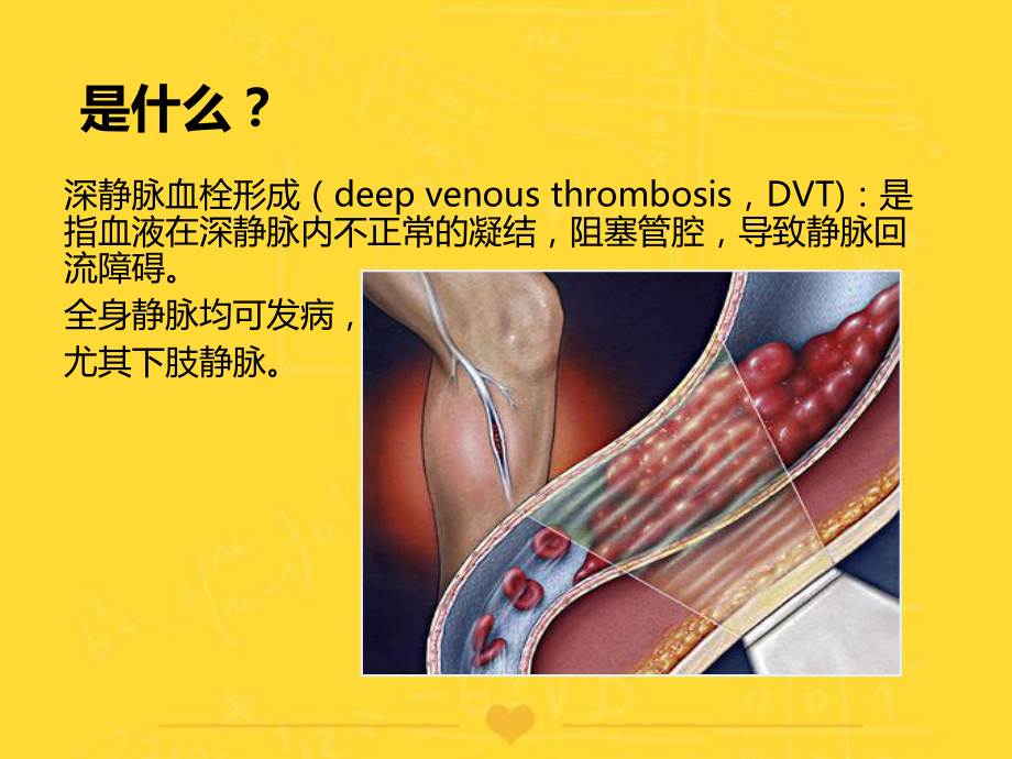 深静脉血栓健康宣教PPT课件.pptx_第3页