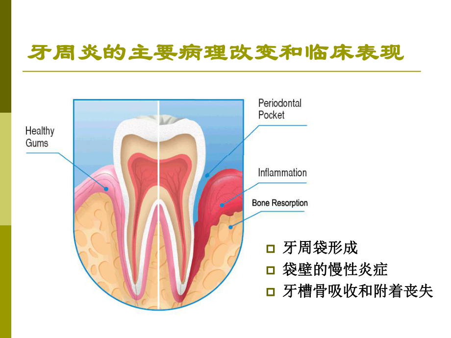 牙周炎的伴发病变课件.ppt_第1页