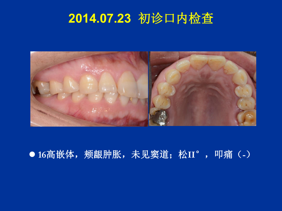 牙纵折体外粘合意向再植术后15个月报告课件.pptx_第3页