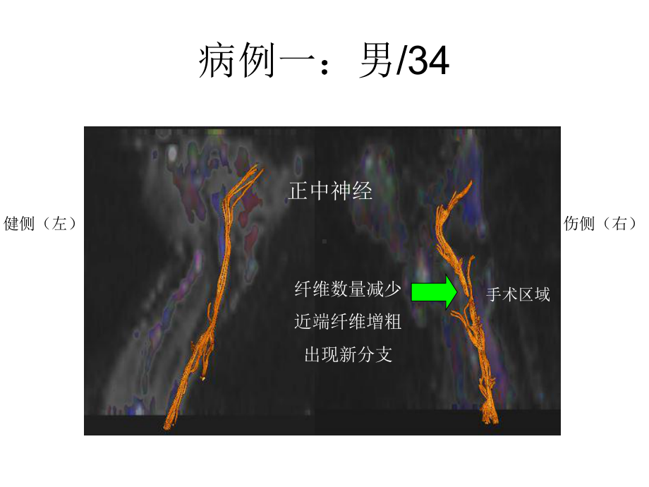 正中神经DTI成像课件.ppt_第2页