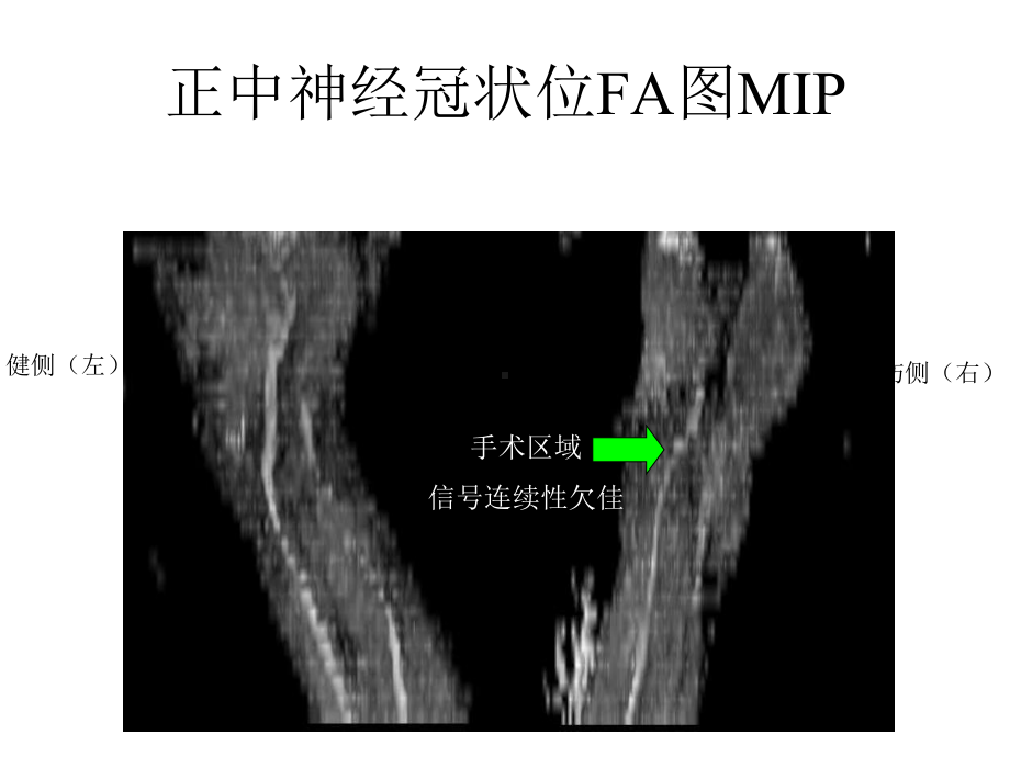 正中神经DTI成像课件.ppt_第3页