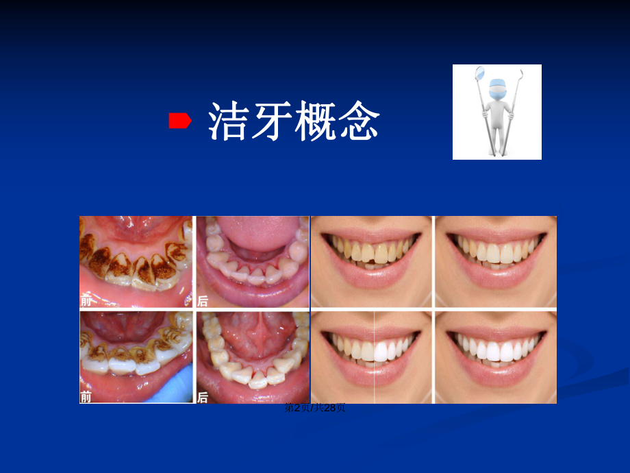 洗牙的常识概念和了解PPT学习教案课件.pptx_第3页