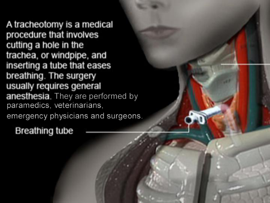 气管切开术(Tracheotomy)课件.ppt_第1页