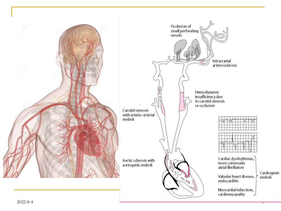炉德宏脑栓塞的病理机制和病理学特点课件.ppt_第3页