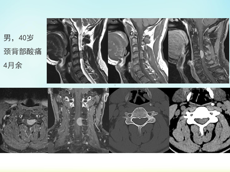 椎管内神经鞘瘤影像表现课件.pptx_第1页