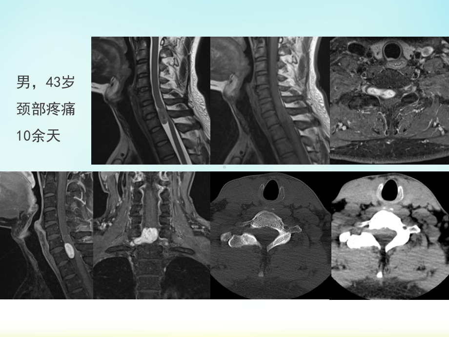 椎管内神经鞘瘤影像表现课件.pptx_第2页