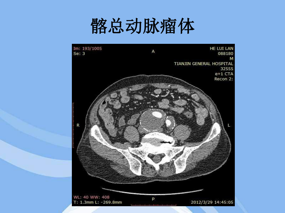 输入道闭塞扭曲的腹主动脉瘤合并髂动脉多发动脉瘤一例课件.ppt_第3页