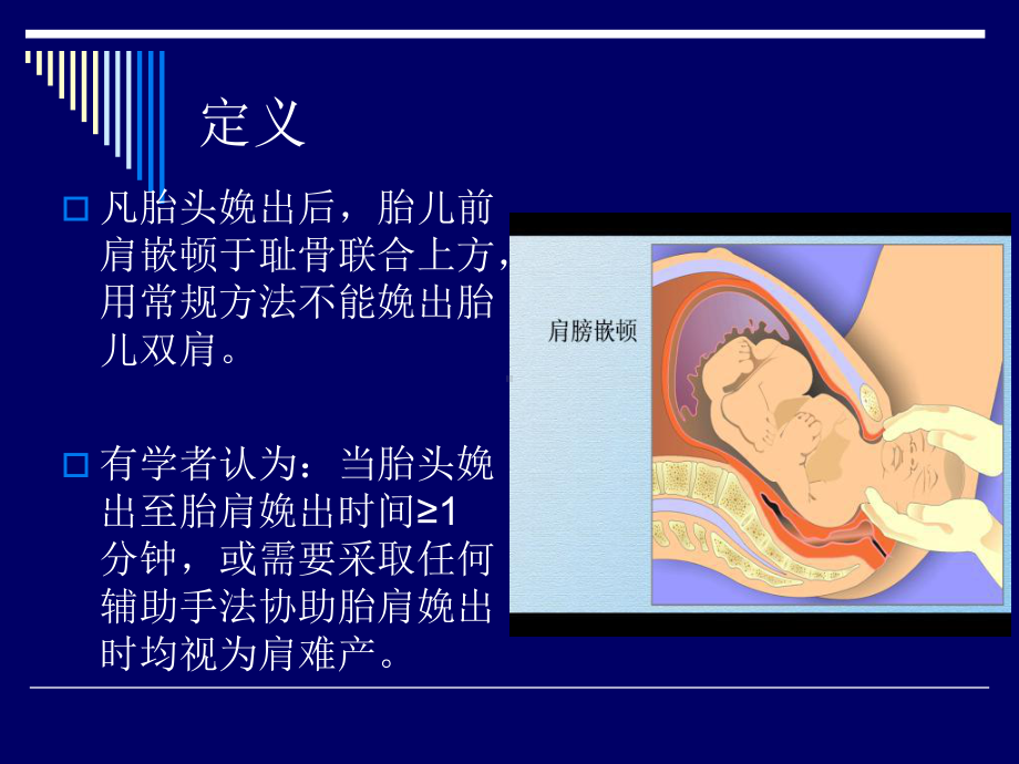 肩难产的紧急处理课件.ppt_第3页