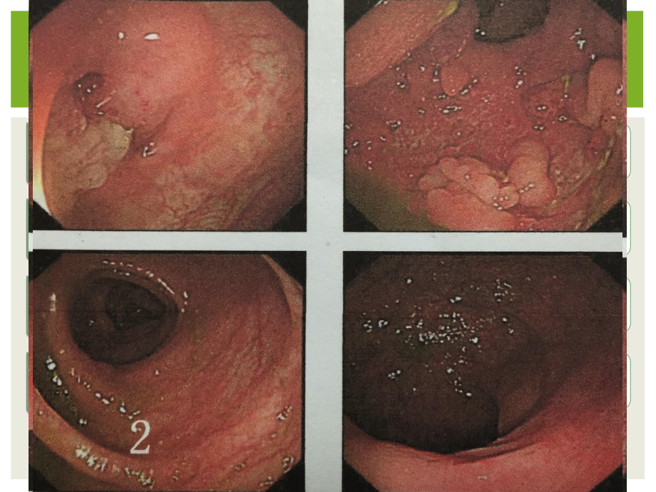 炎性肠病巡诊课件.pptx_第3页