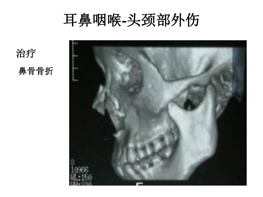 耳鼻咽喉-头颈外科学-鼻部疾病课件.ppt_第3页