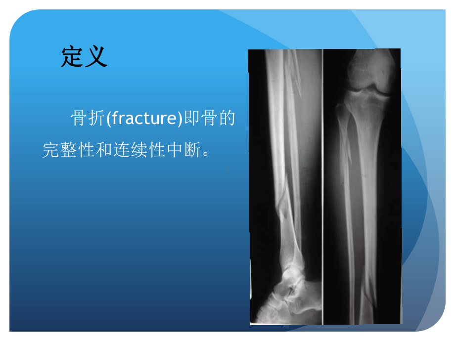 骨折概论-外科学课件.ppt_第3页