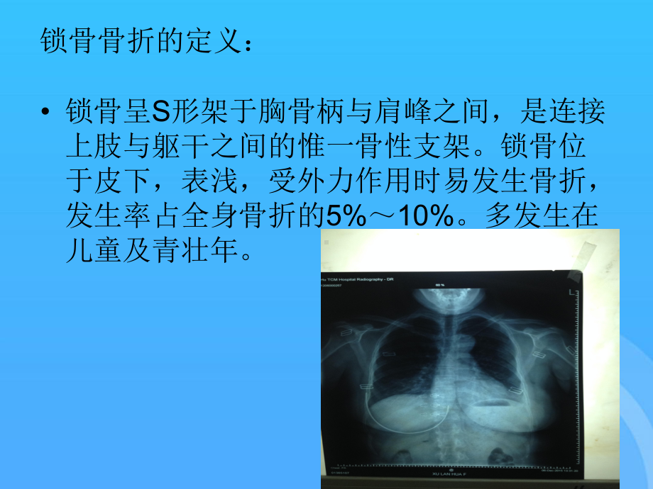 锁骨骨折护理查房PPT课件.pptx_第2页