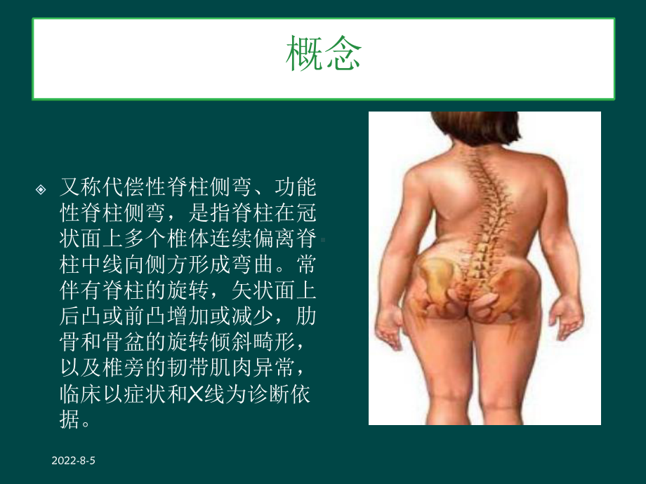 特发性脊柱侧弯课件.ppt_第3页