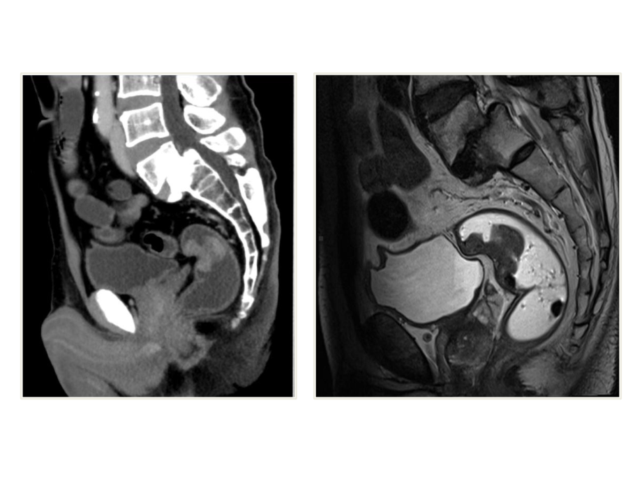 高分辨MRI在直肠癌中应用实例课件.ppt_第2页