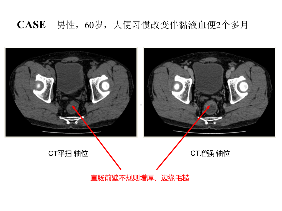 高分辨MRI在直肠癌中应用实例课件.ppt_第3页