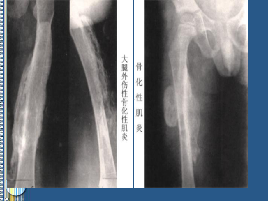 骨化性肌炎PPT课件.pptx_第2页