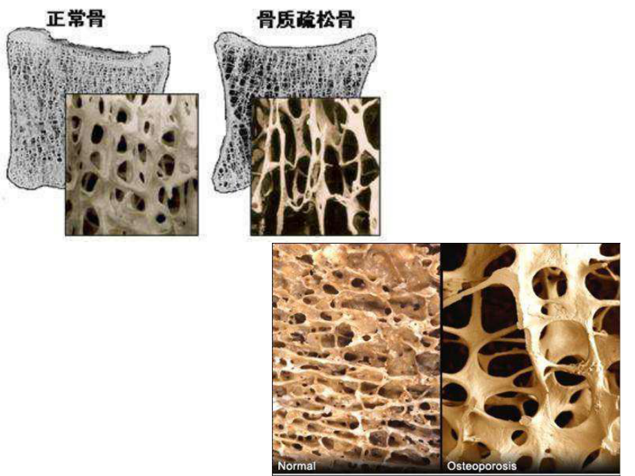 骨质疏松性骨折(同名58)课件.ppt_第3页