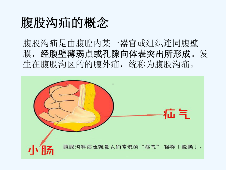 腹股沟斜疝健康宣教[可修改版ppt]课件.ppt_第2页