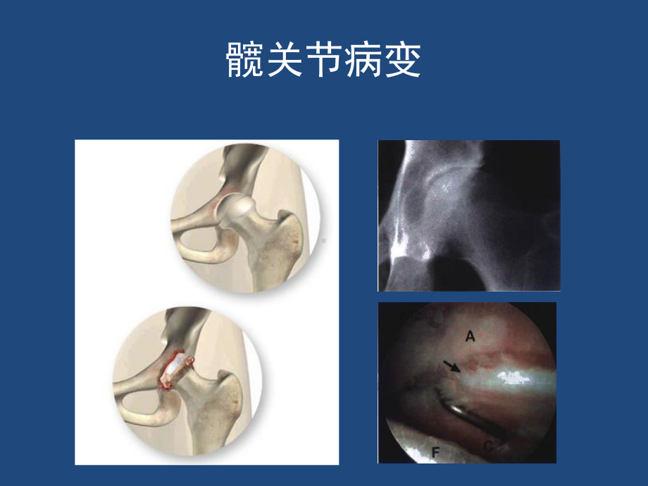 髋关节解剖与入路课件.pptx_第3页