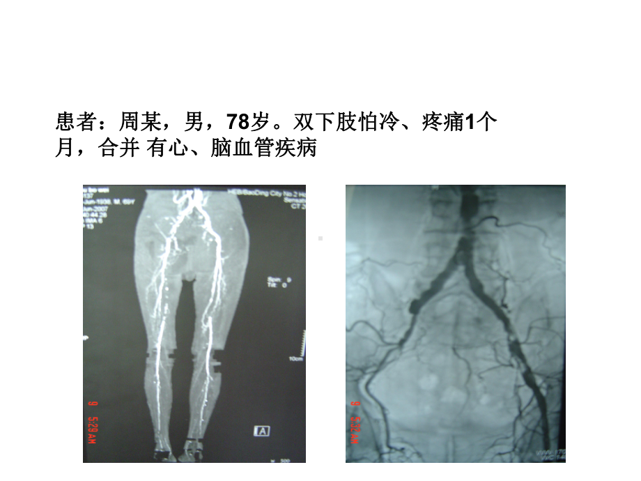 选择适当的方法治疗下肢动脉闭塞性疾病课件.ppt_第2页