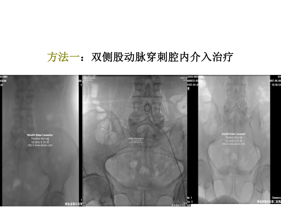 选择适当的方法治疗下肢动脉闭塞性疾病课件.ppt_第3页