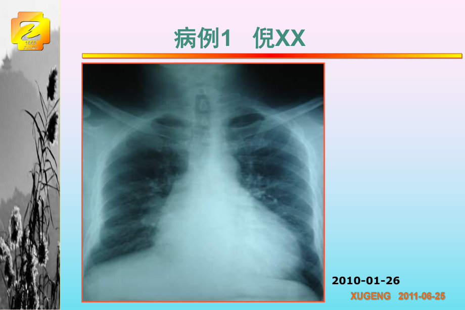 轻度心衰CRT时机已经来到循证医学证据解读课件.ppt_第2页