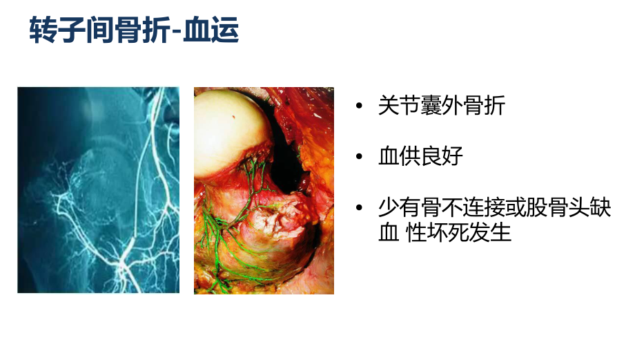 转子间骨折课件.pptx_第3页