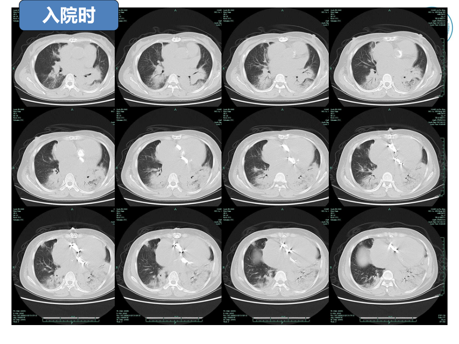 重症肺炎抗感染策略课件.ppt_第3页