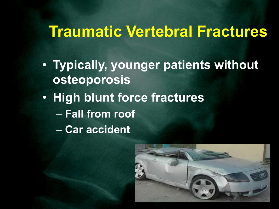 椎体成形术治疗外伤性椎体压缩性骨折(外)课件.ppt_第2页