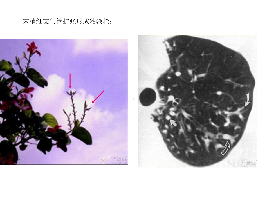 胸部ct常见征象集萃课件.ppt_第3页