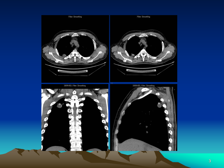 肺错构瘤影像表现PPT课件.ppt_第3页
