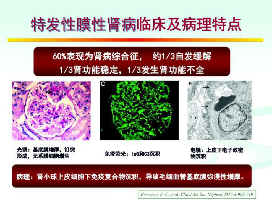 膜性肾病治疗策略课件.ppt_第2页