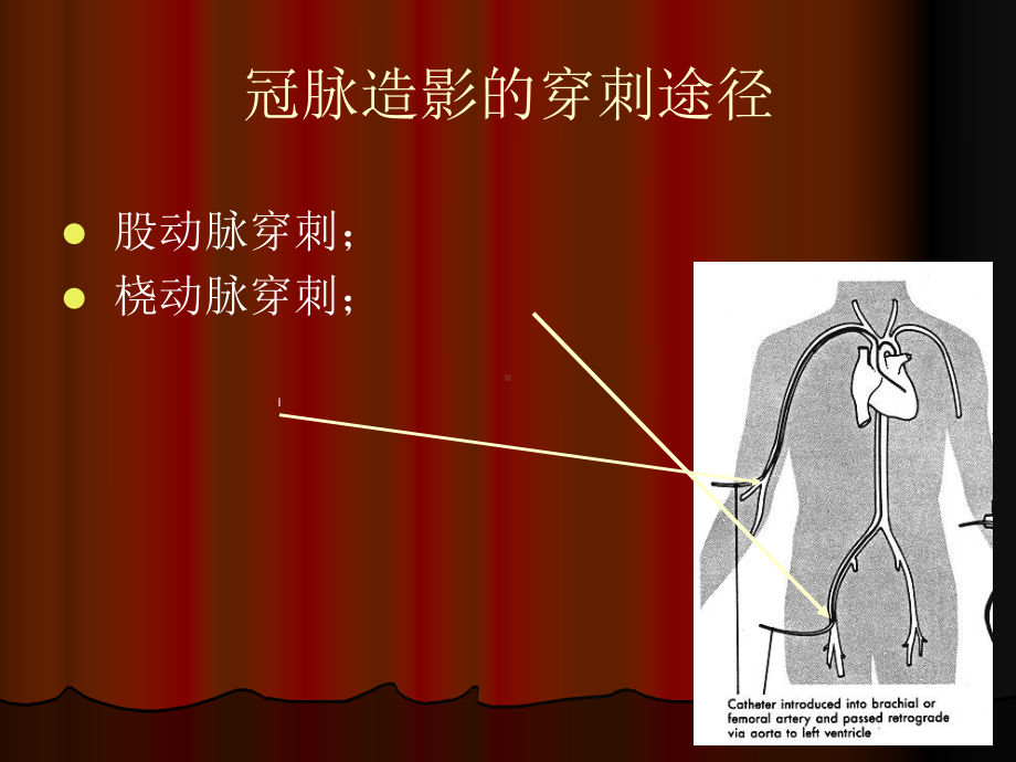 经股动脉冠脉造影术课件.ppt_第3页