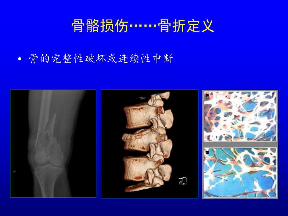 骨折概论-课件.ppt_第2页