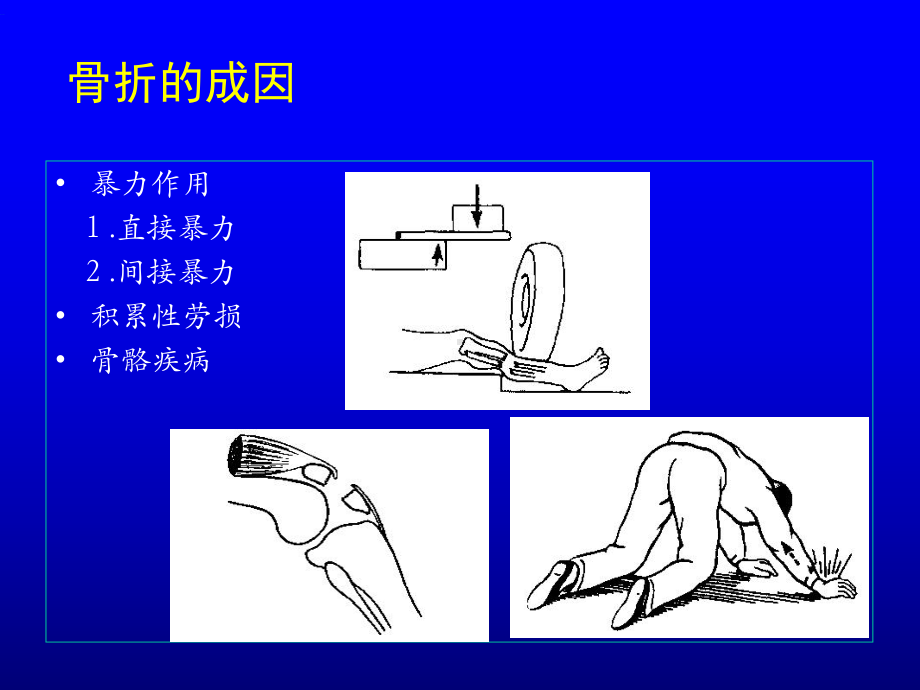 骨折概论-课件.ppt_第3页