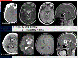 鞍区生殖细胞瘤课件.pptx