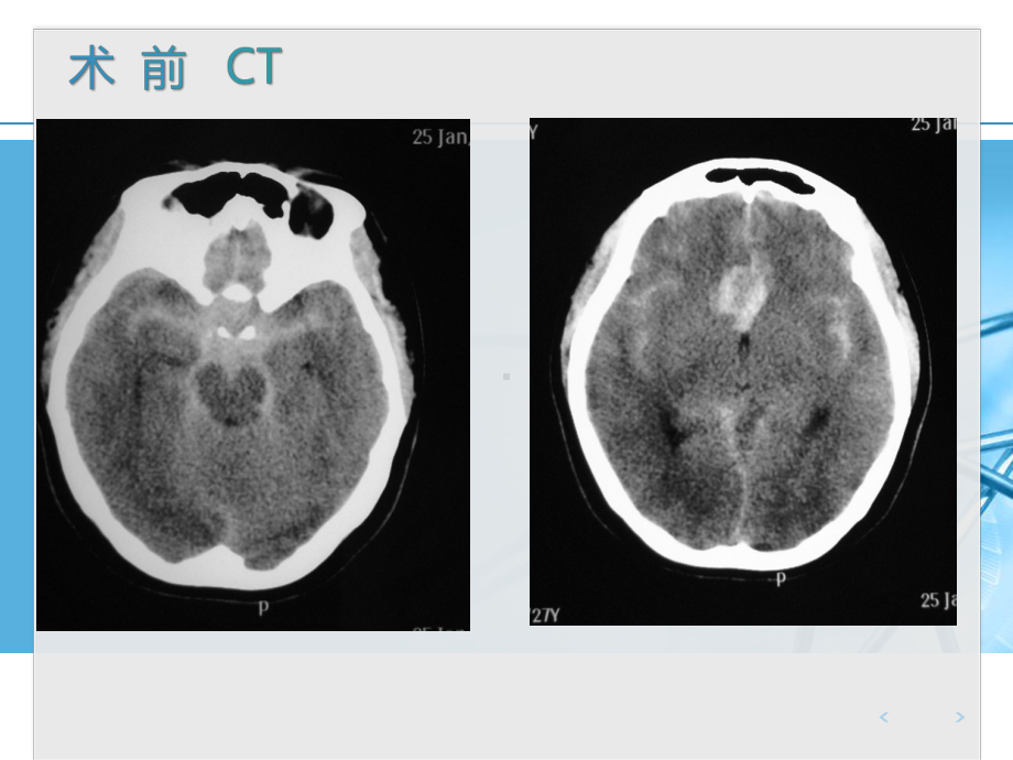 颅内压监测在动脉瘤术后应用病例课件.pptx_第3页