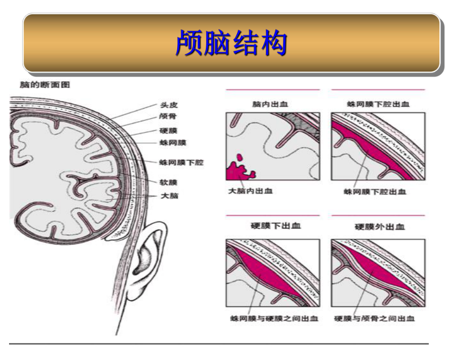 蛛网膜下腔出血的护理知识课件.ppt_第3页